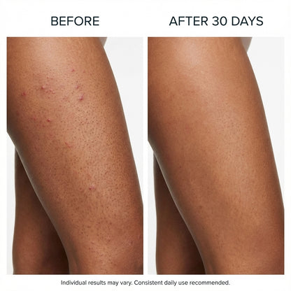 Triple-Acid Complex Cream